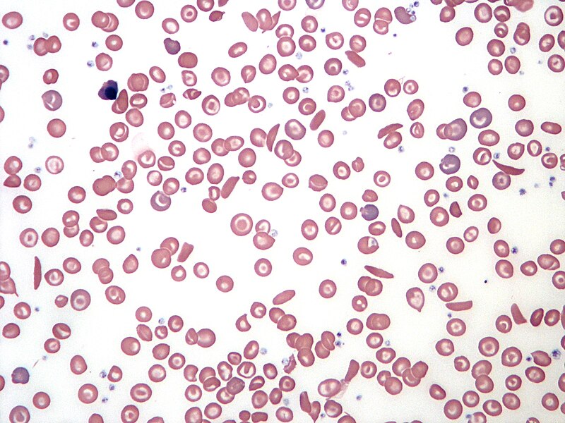 File:Sickle Cell Blood Smear.JPG