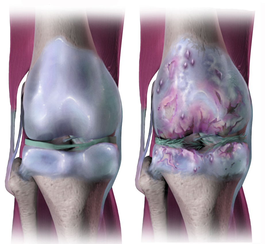 A diagram showing osteoarthiritis in the knee, with cartilage degrading and the joint narrowing in width