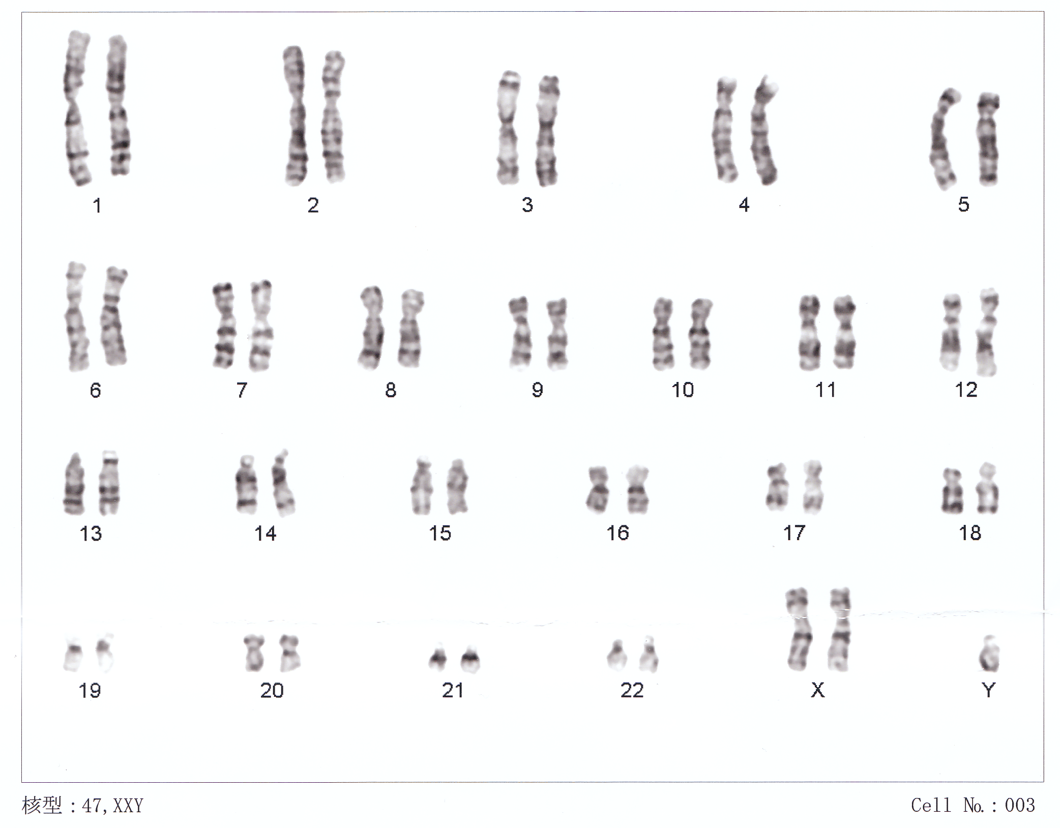 A human karotype with XXY The chromosomes of a person with XXY, often called Klinefelter syndrome